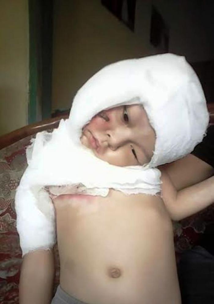 Jassen, Bocah Yang Tercebur ke Penggorengan Masih Punya Hutang di RSI Lumajang